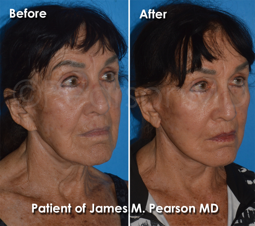 Pearson Plastic Surgery
