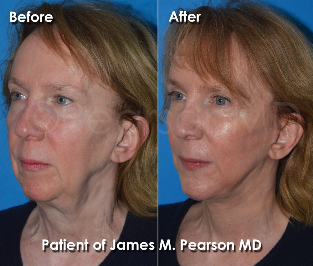 Dr. Pearson Plastic Surgeon