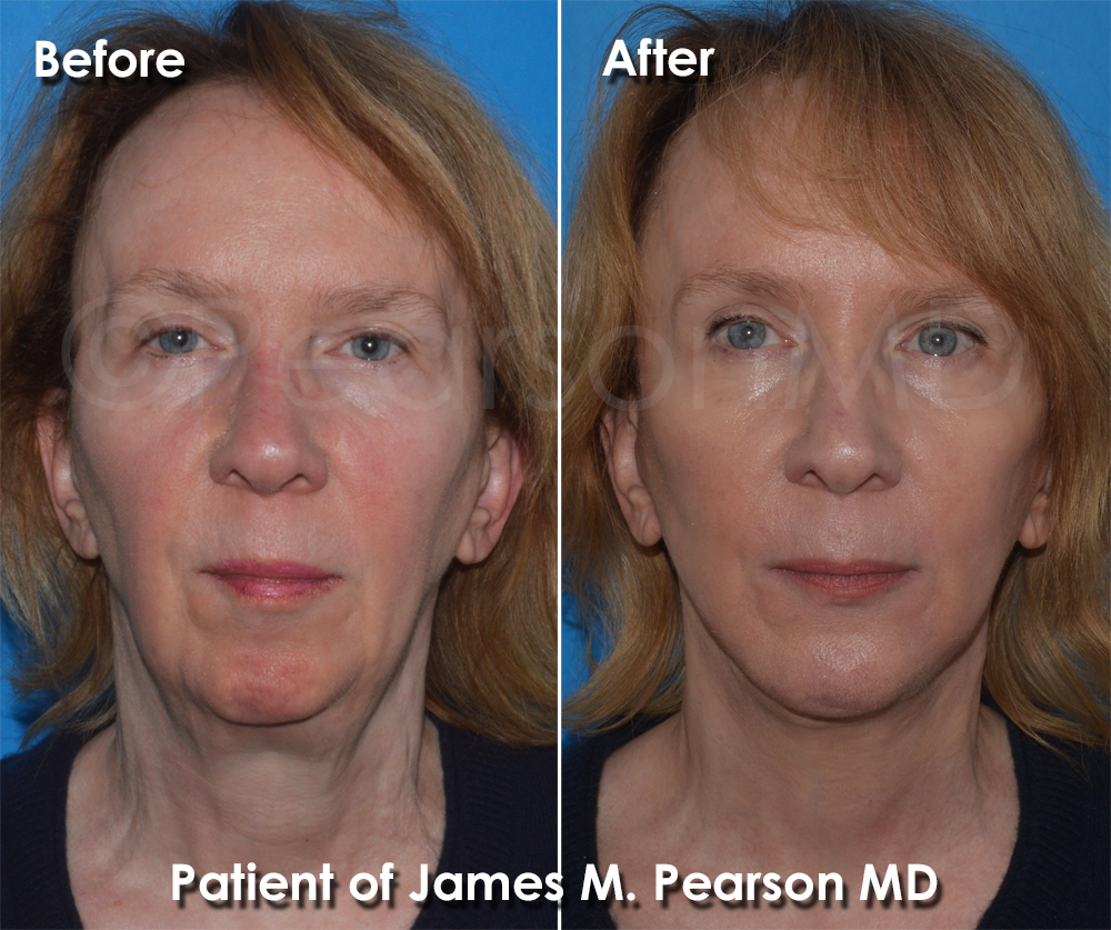 Pearson Plastic Surgery