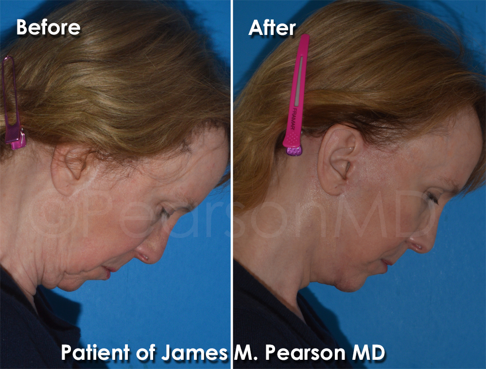 Pearson Plastic Surgery