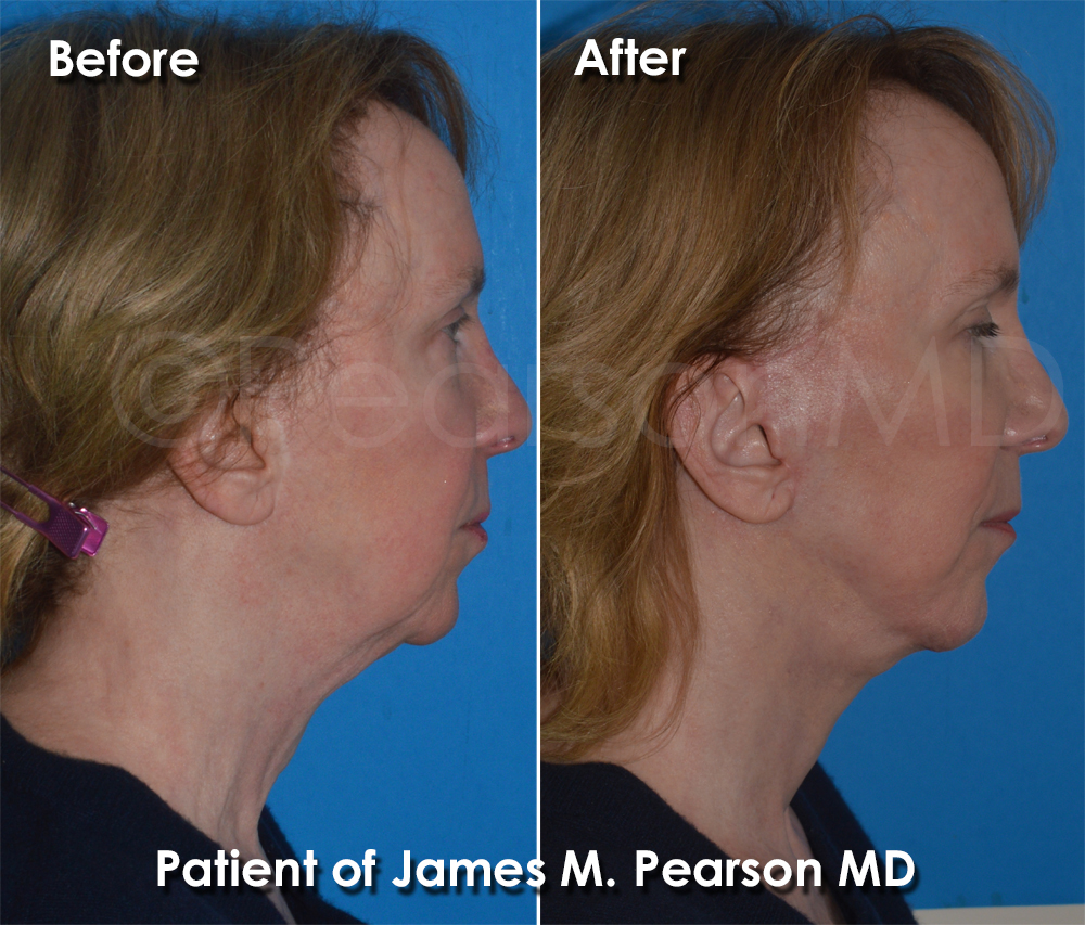 Pearson Plastic Surgery