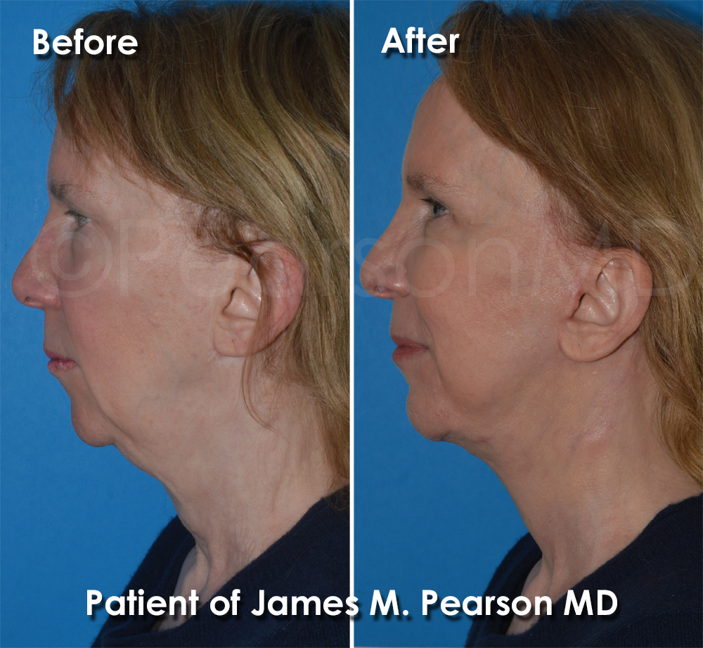 Pearson Plastic Surgery