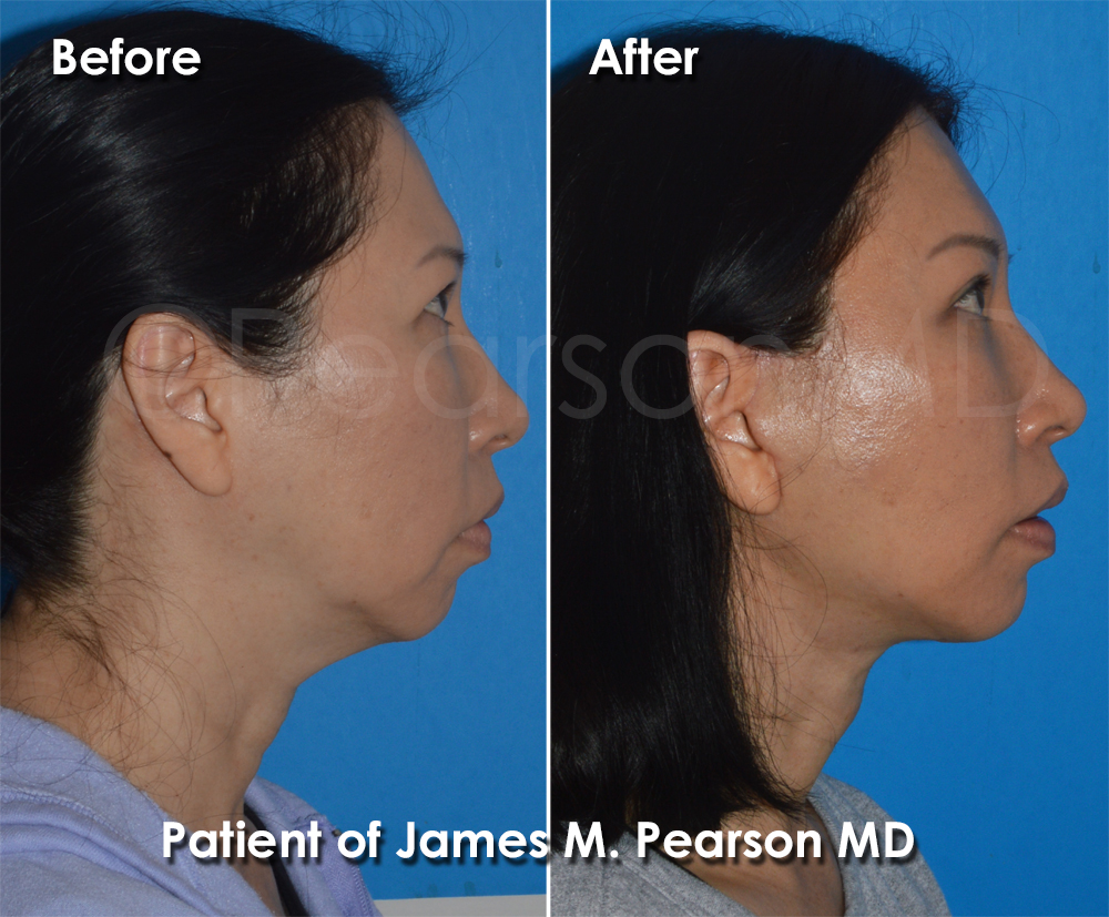 Pearson Plastic Surgery