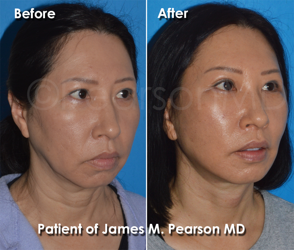 Pearson Plastic Surgery