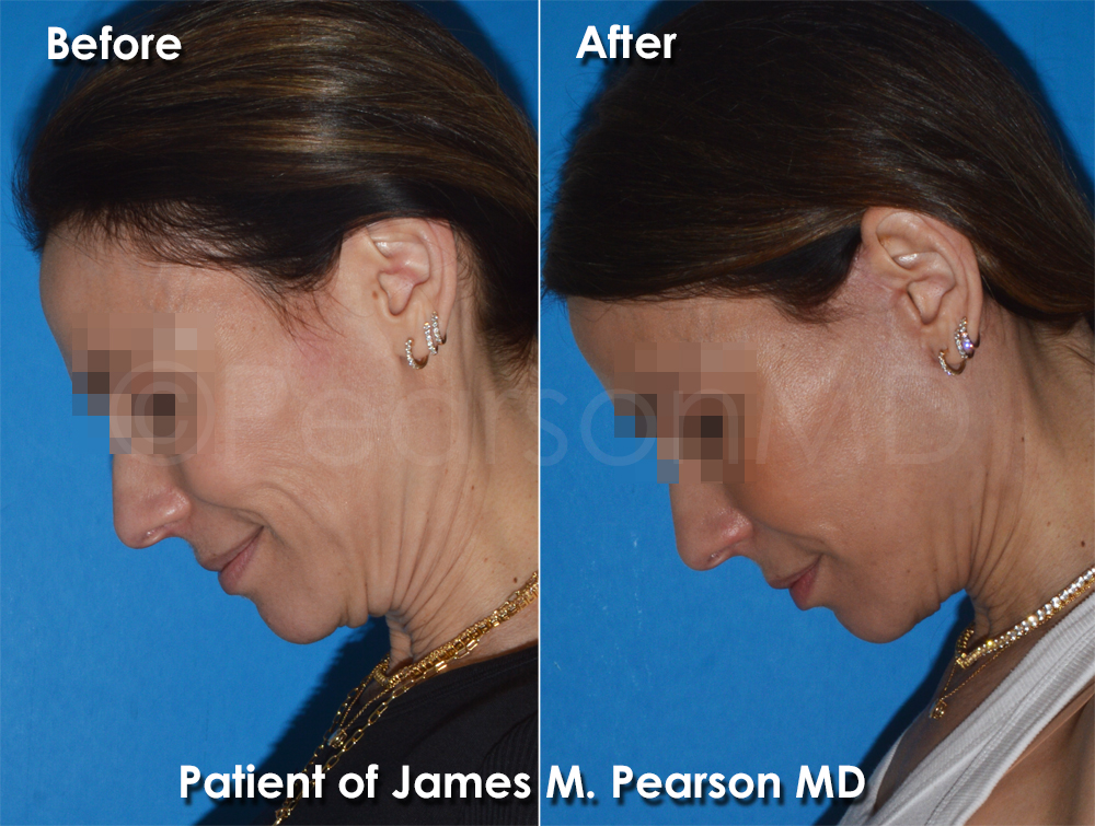 Pearson Plastic Surgery