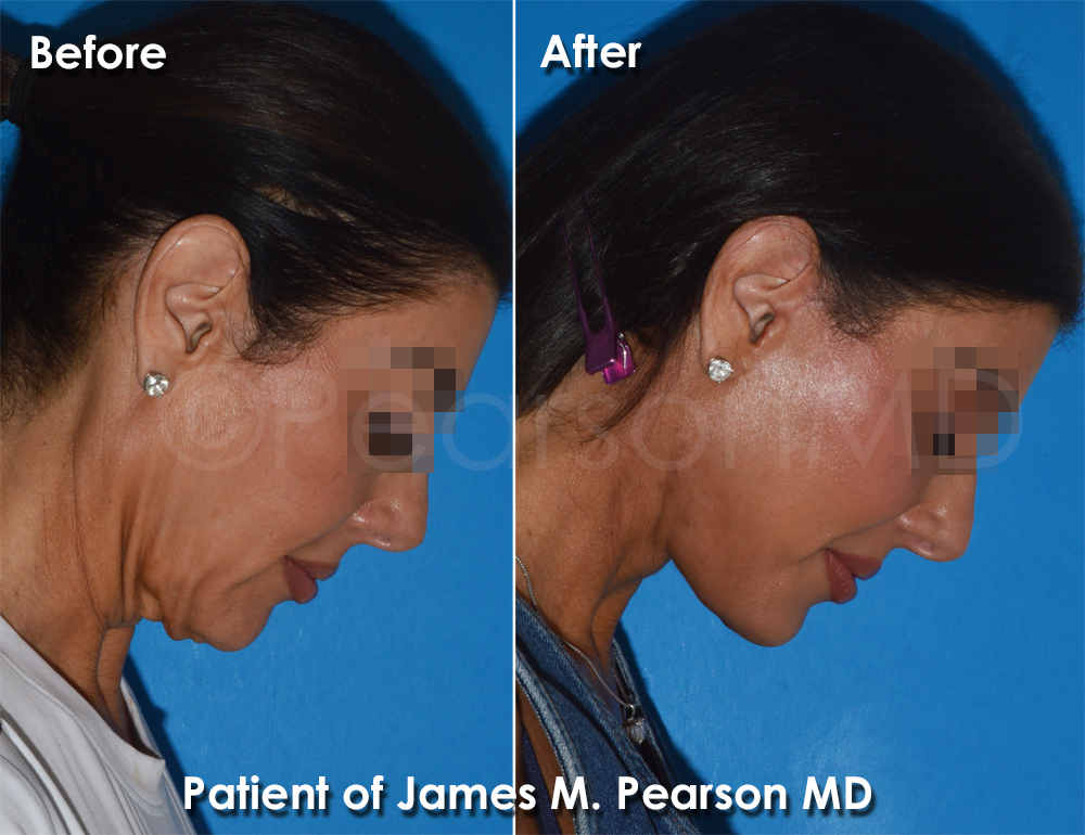 Pearson Plastic Surgery