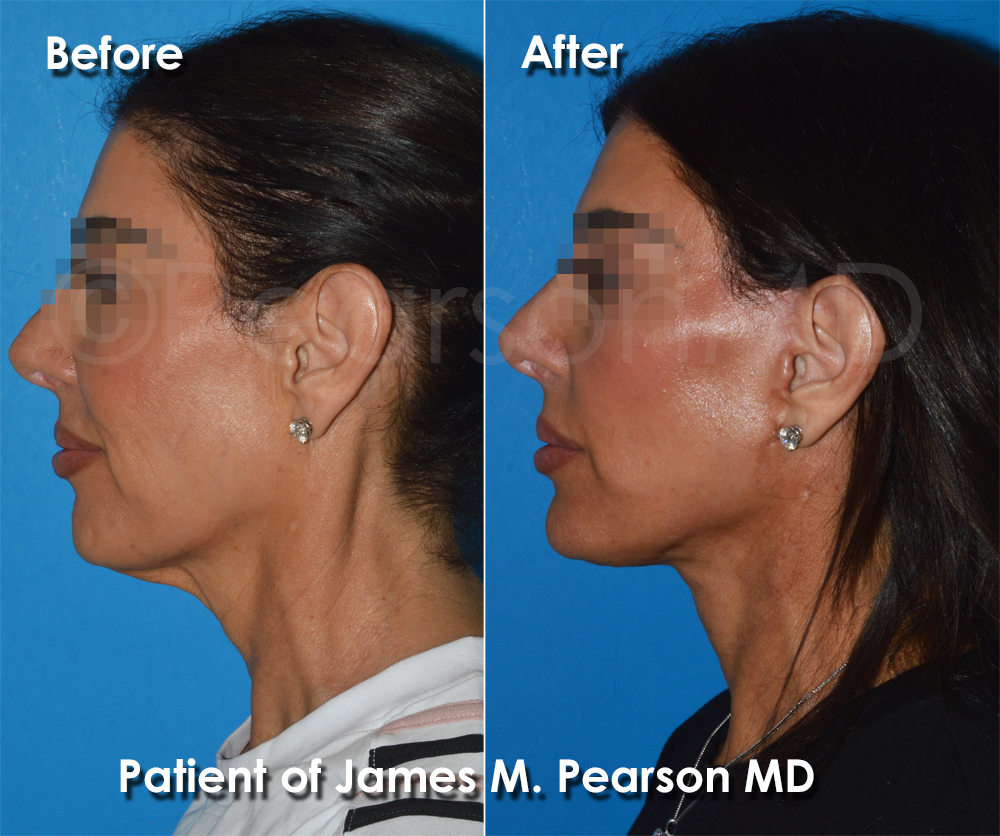 Pearson Plastic Surgery