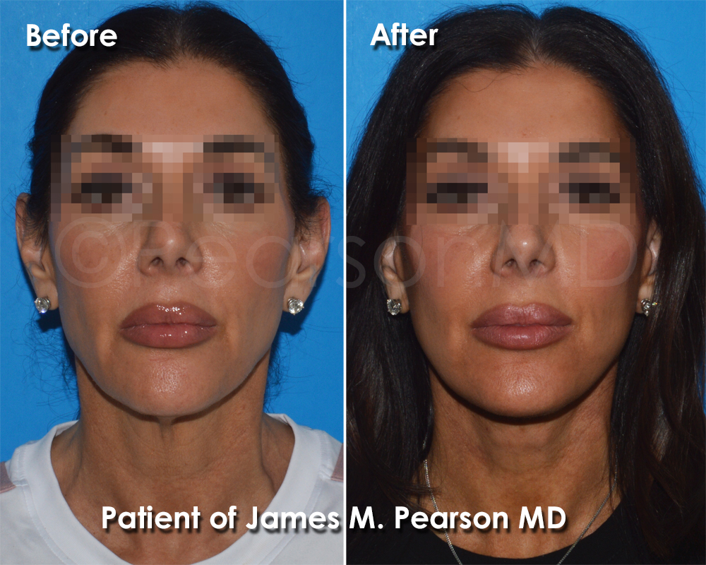 Pearson Plastic Surgery