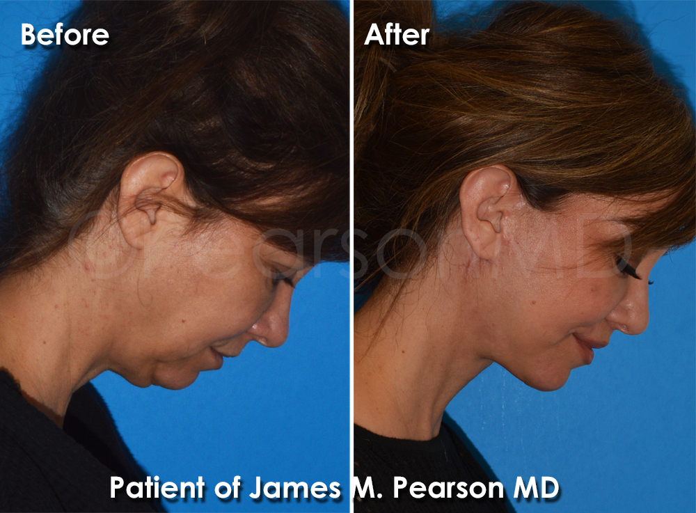 Pearson Plastic Surgery