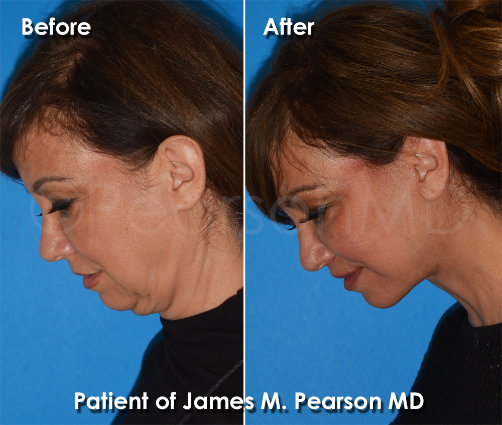Dr. Pearson Plastic Surgeon