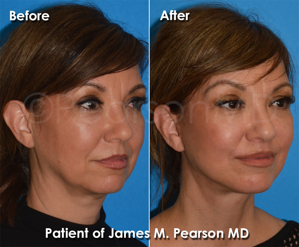 Pearson Plastic Surgery