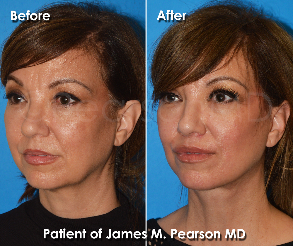 Pearson Plastic Surgery