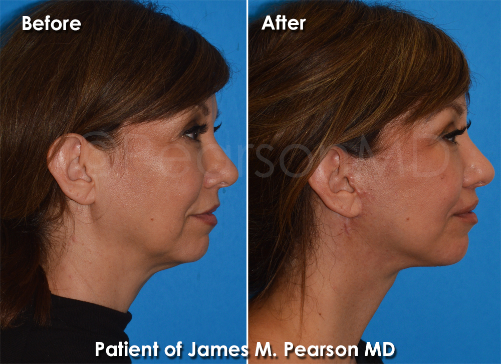 Pearson Plastic Surgery