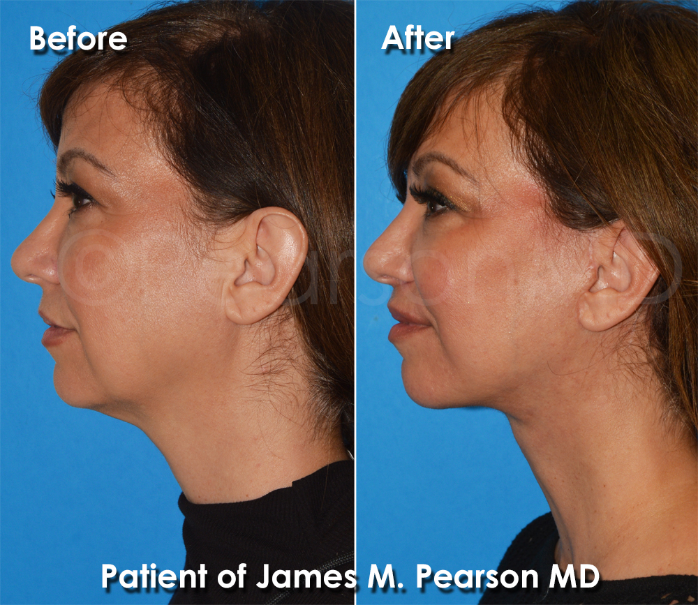 Pearson Plastic Surgery