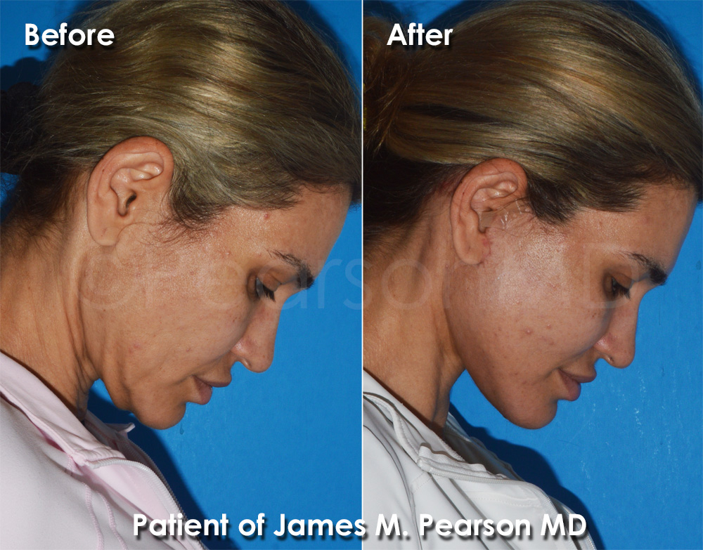 Pearson Plastic Surgery Facelift
