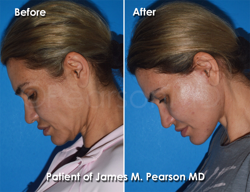 Pearson Plastic Surgery Facelift