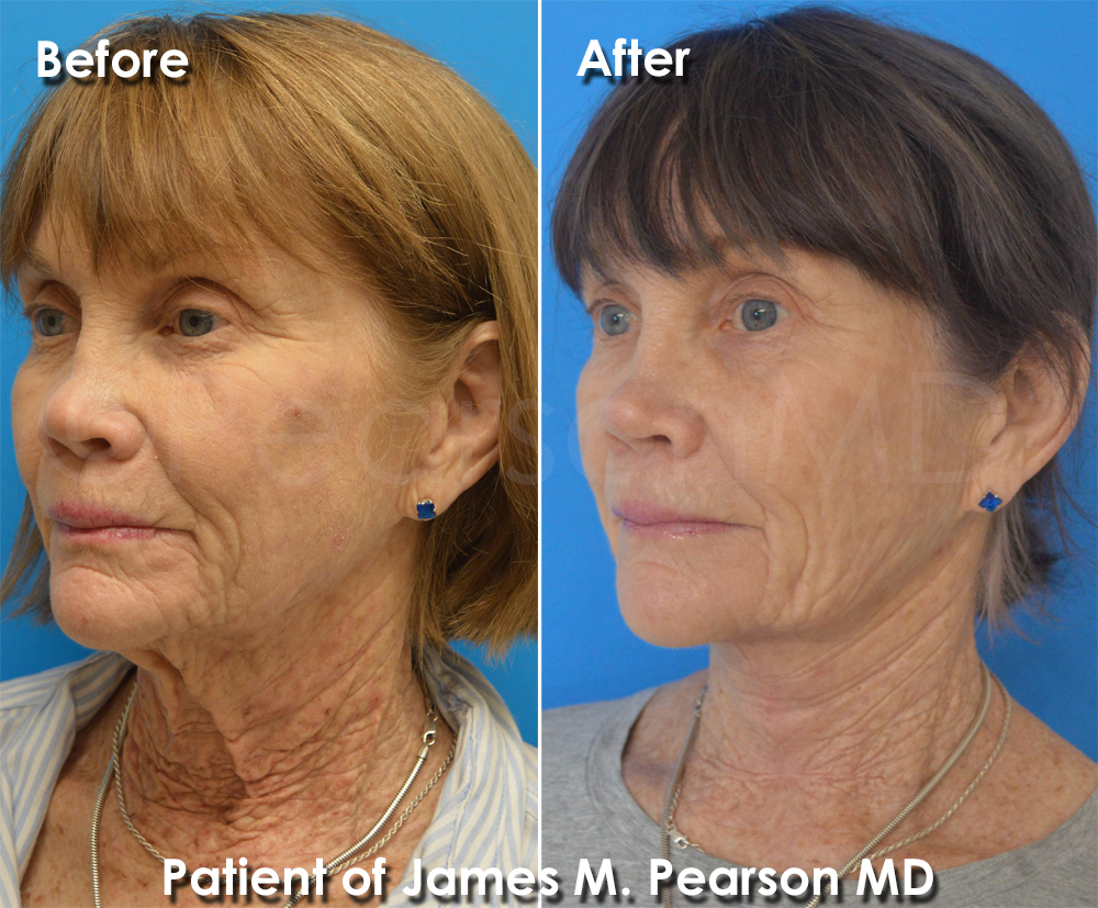 Pearson Plastic Surgery