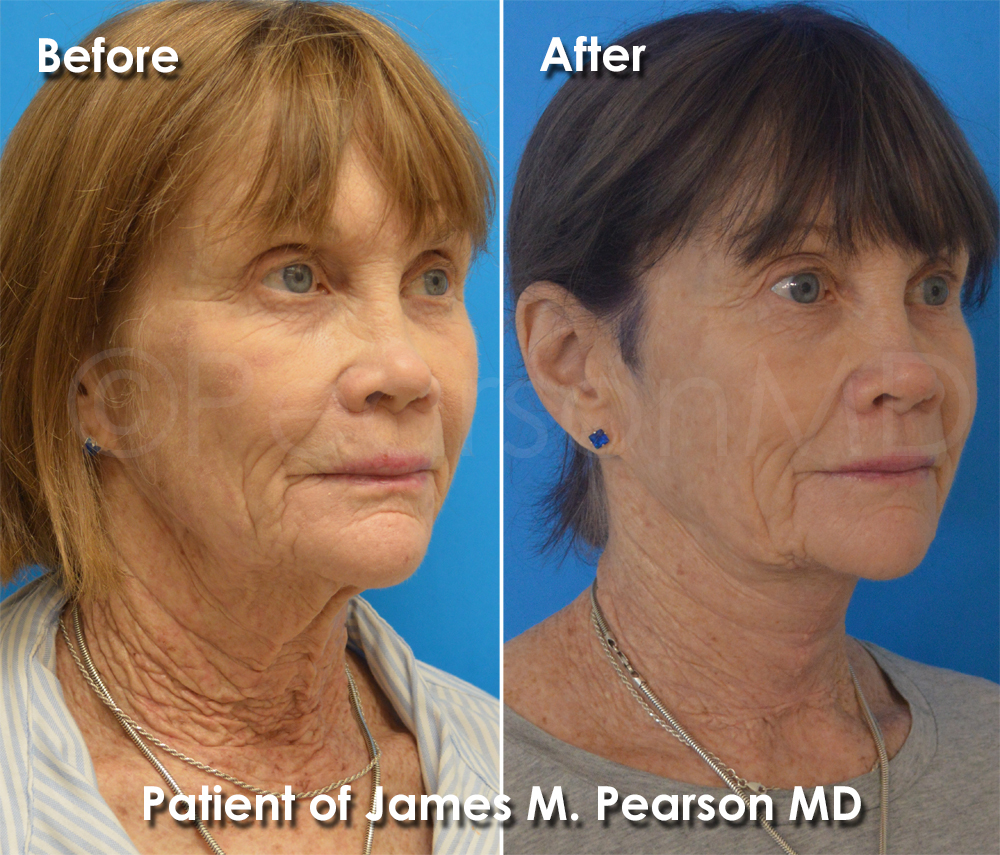 Pearson Plastic Surgery