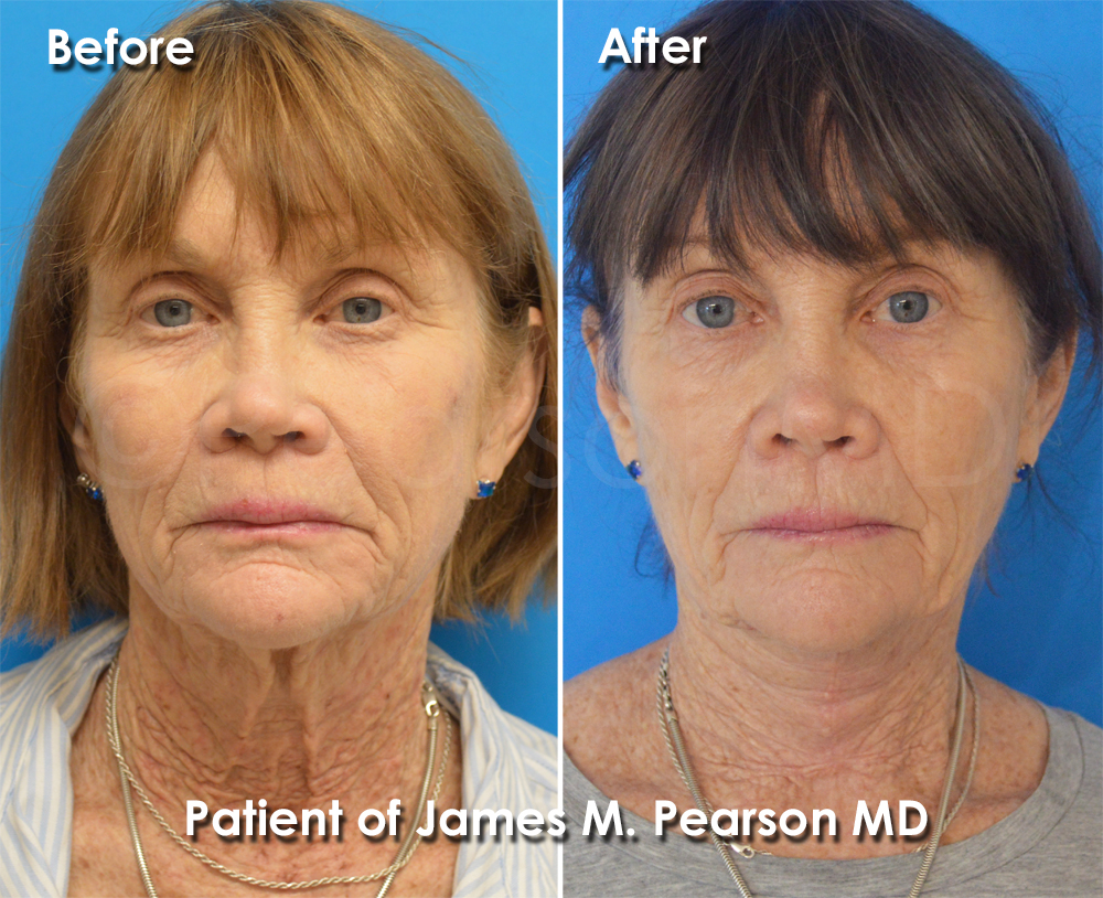 Pearson Plastic Surgery