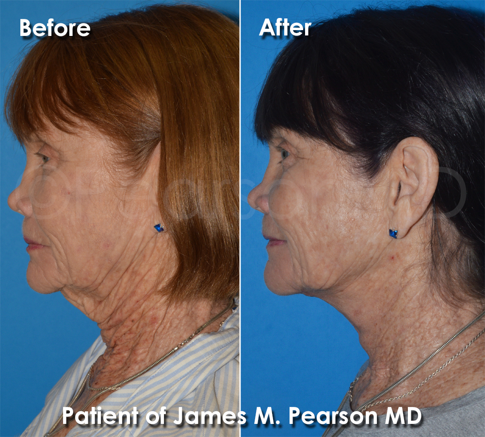 Pearson Plastic Surgery