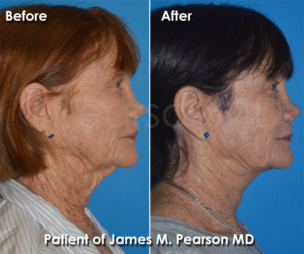 Pearson Plastic Surgery