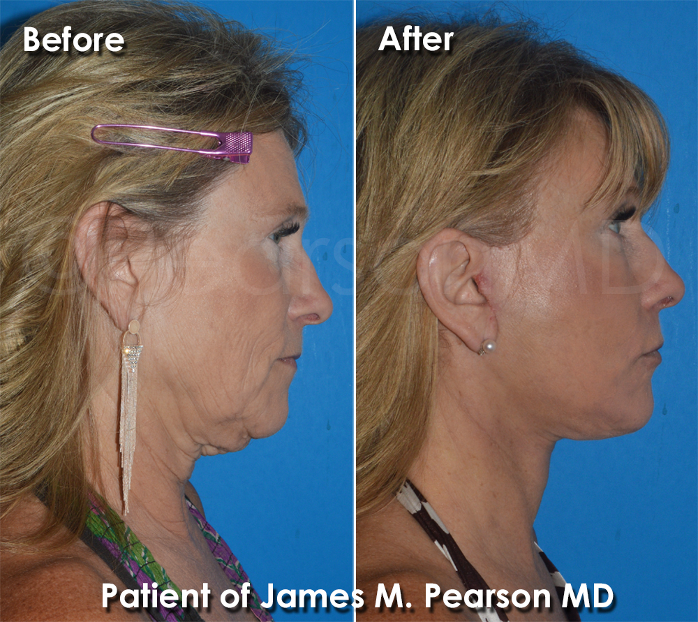 Pearson Plastic Surgery