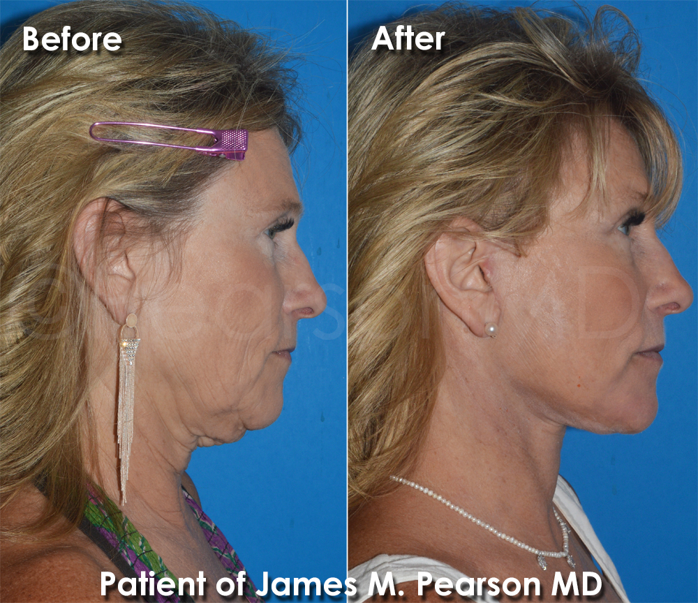 Pearson Plastic Surgery