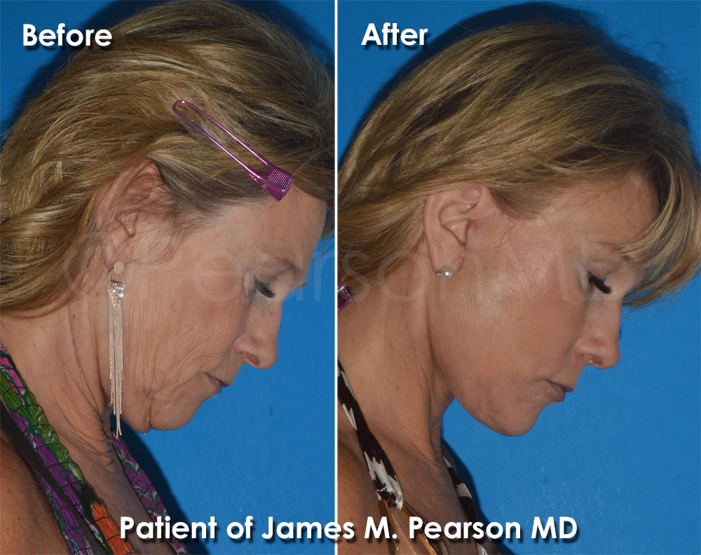 Pearson Plastic Surgery