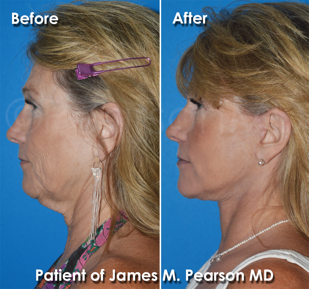 Facelift - Pearson Plastic Surgery
