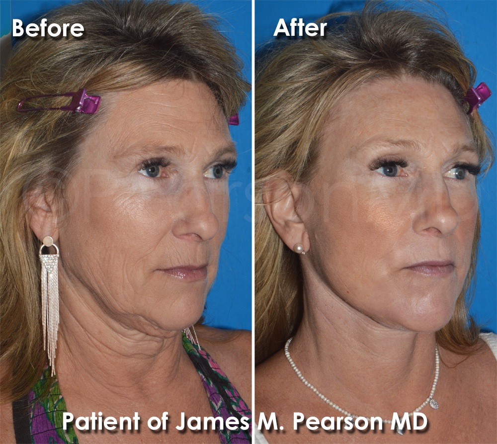 Facelift - Pearson Plastic Surgery