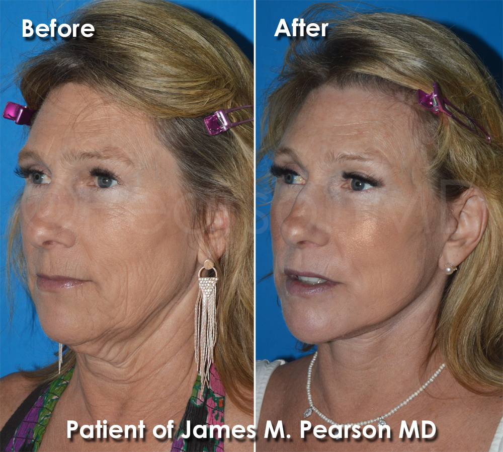Pearson Plastic Surgery