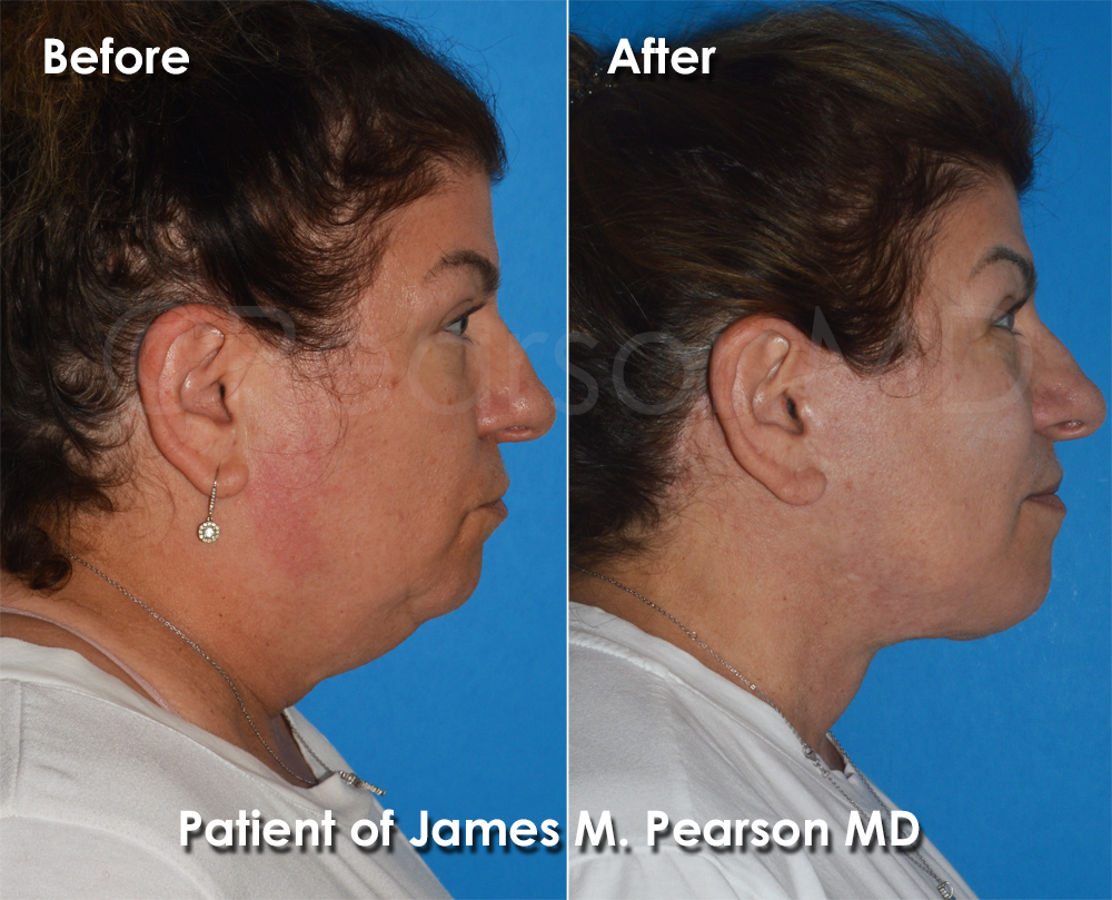 Pearson Plastic Surgery