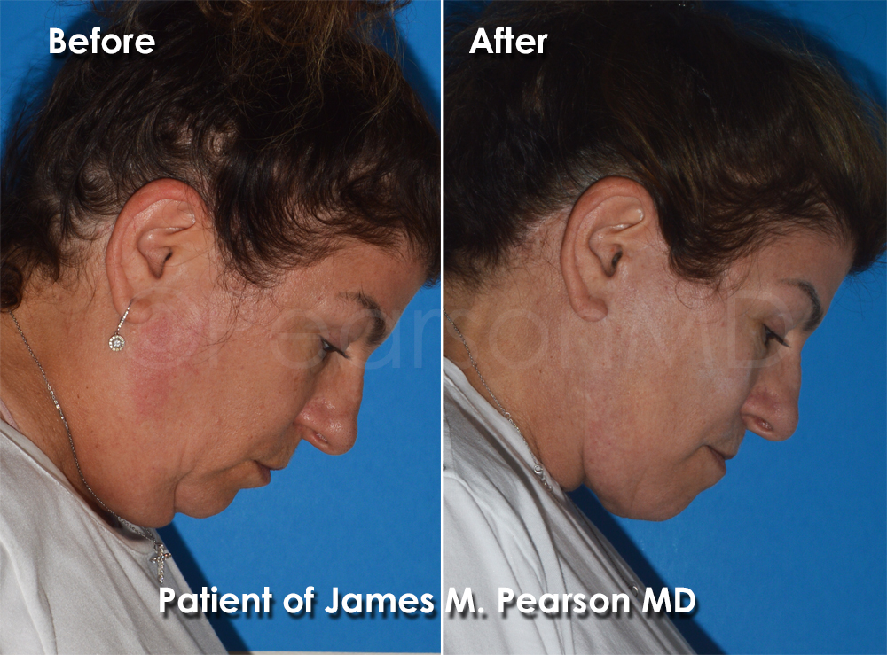Pearson Plastic Surgery