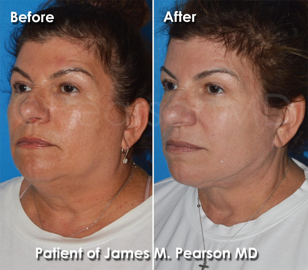 Pearson Plastic Surgery