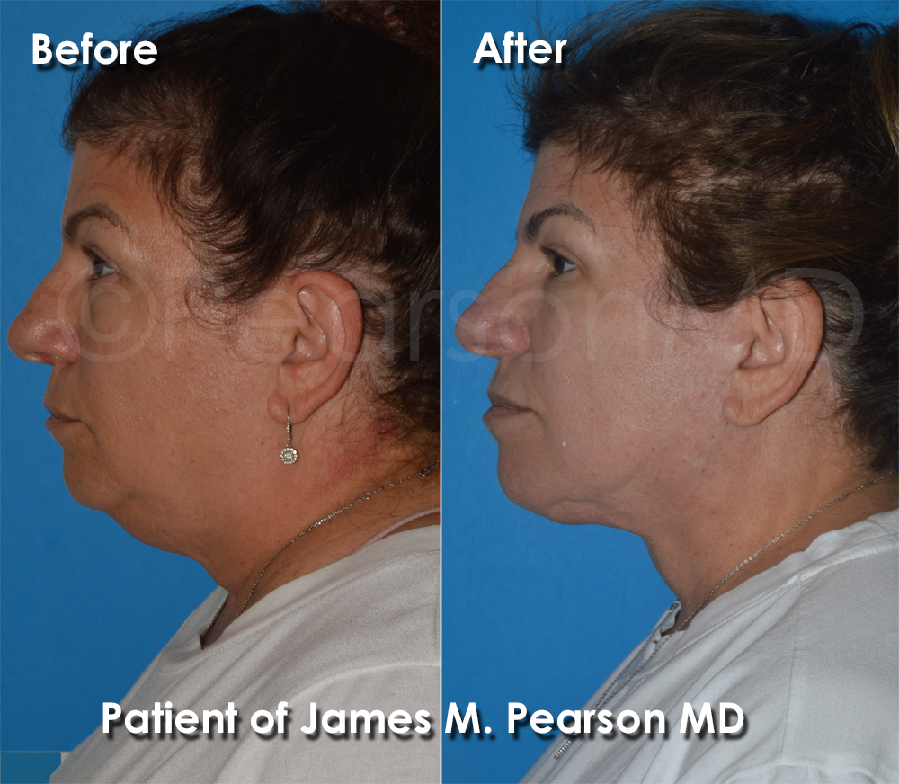 Facelift Dr. Pearson Plastic Surgery