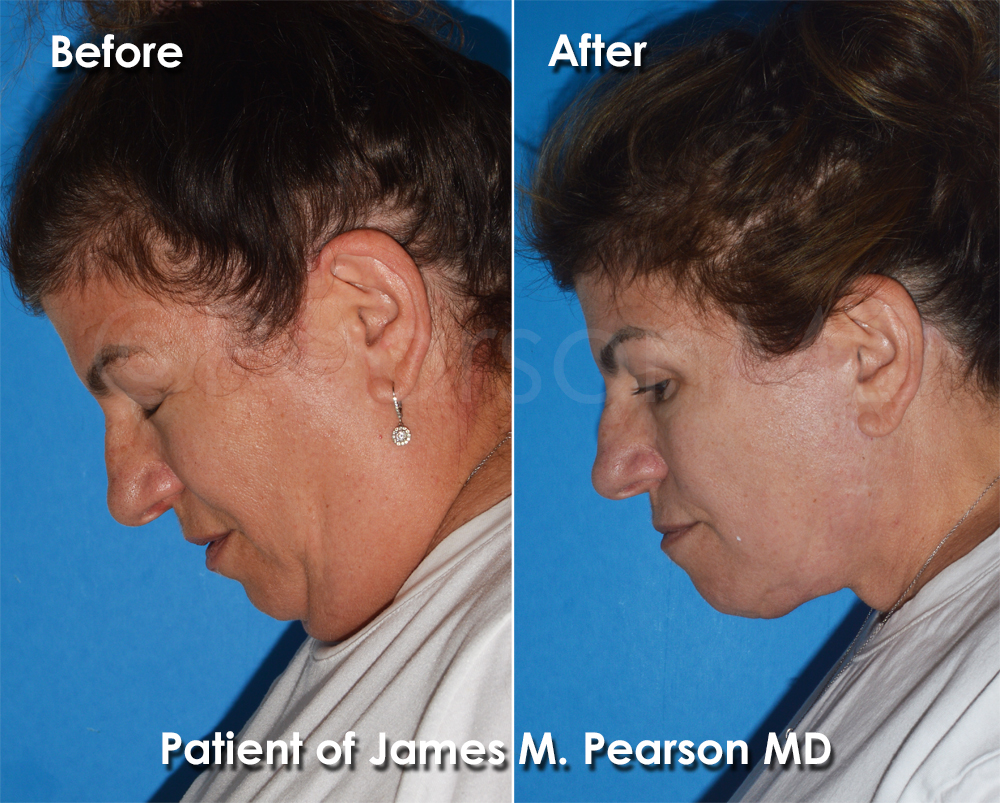 Pearson Plastic Surgery