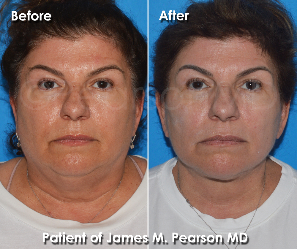 Facelift Dr. Pearson Plastic Surgery