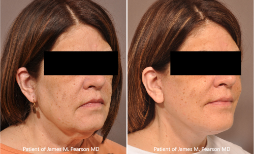 Photos Pearson Facelift
