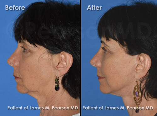 Pearson Facelift Photos