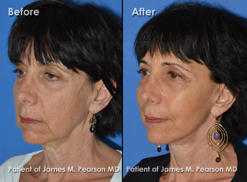 Pearson Facelift Photos
