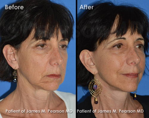 Pearson Facelift Photos