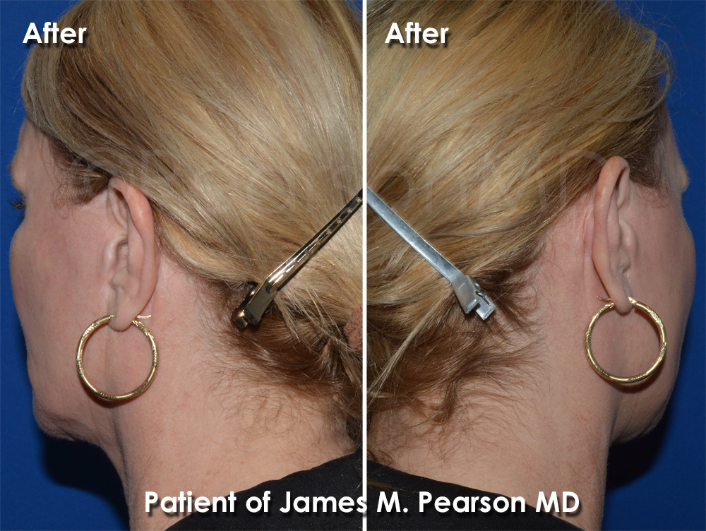 Dr. Pearson Facelift Incision