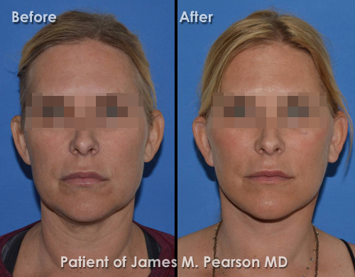 Photos Redondo Beach Facelift Dr. James Pearson Facial Plastic Surgery Photos Pearson Redondo Beach Facelift