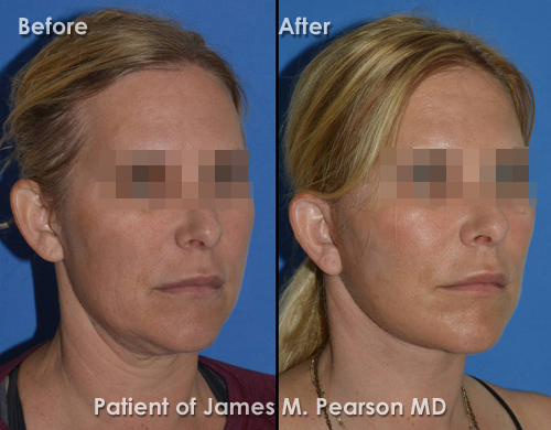 Photos Hermosa Beach Facelift Dr. James Pearson Facial Plastic Surgery Photos Pearson Hermosa Beach Facelift