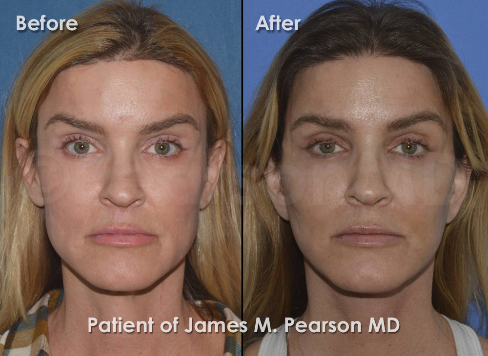 Pearson Facelift
