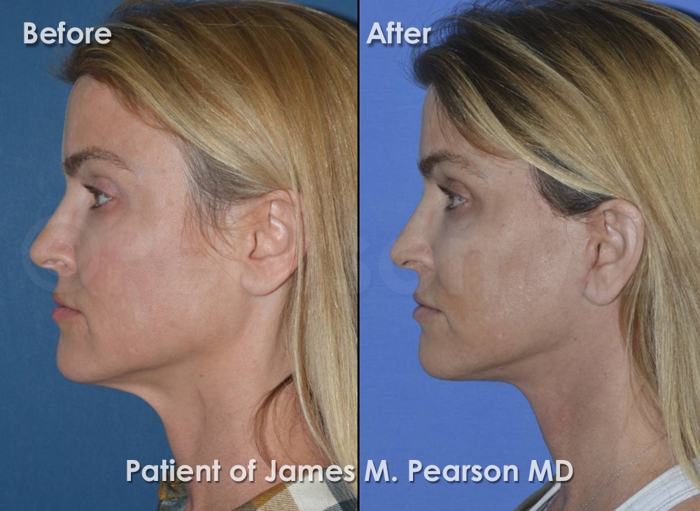 Pearson Facelift