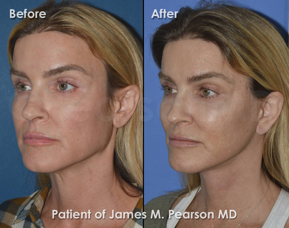 Pearson Facelift