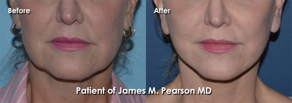 Dr. Pearson Facelift