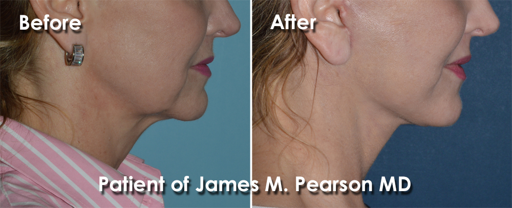 Pearson Facelift