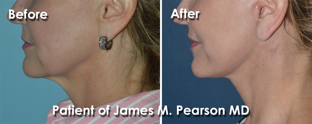 Pearson Facelift Photo